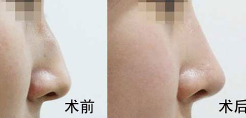 駝峰鼻矯正的方法有哪些？駝峰鼻矯正的方式及適合人群？