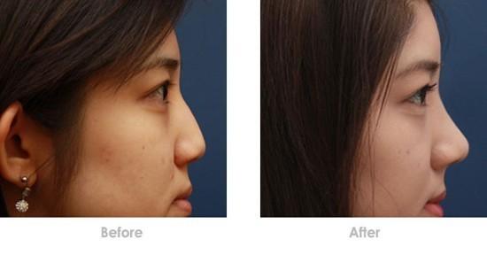 隆鼻假體取出后鼻子會(huì)不會(huì)變形？隆鼻假體取出后能不能恢復(fù)原樣？