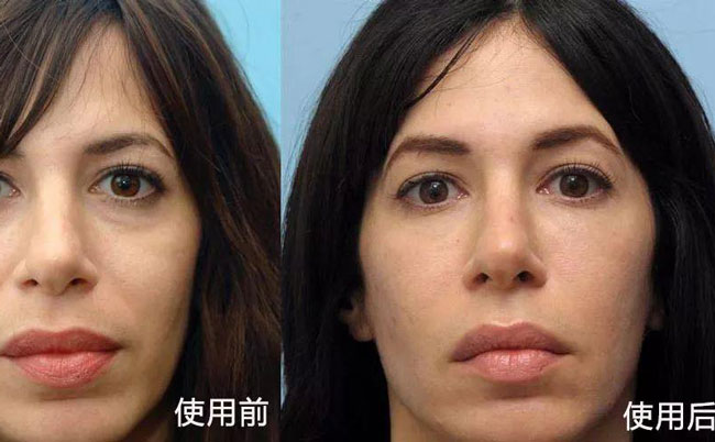 法令紋去除手術(shù)效果好嗎？法令紋怎么消除?最好的方法是什么？