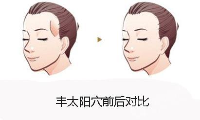 什么是自體脂肪豐太陽穴？用自體脂肪豐太陽穴的效果能維持多久？