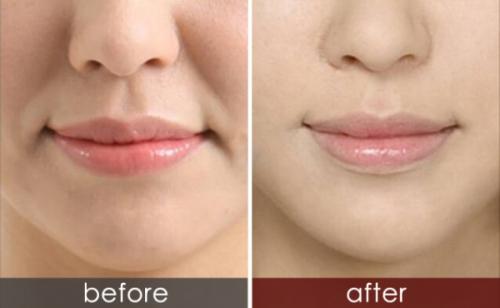 玻尿酸祛除法令紋的優(yōu)勢？玻尿酸和肉毒素祛法令紋，哪一種效果好？