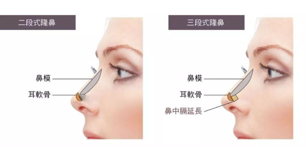 自體軟骨隆鼻的手術(shù)優(yōu)缺點有哪些？肋軟骨填充鼻基底多久能自然？