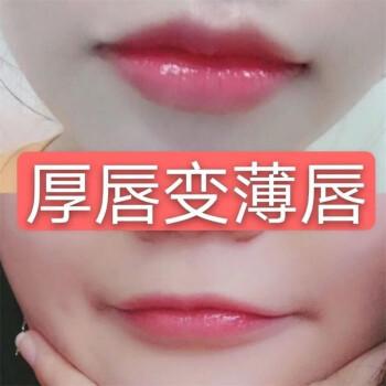 厚唇改薄整形手術(shù)價格？厚唇改薄多久完全恢復(fù)？