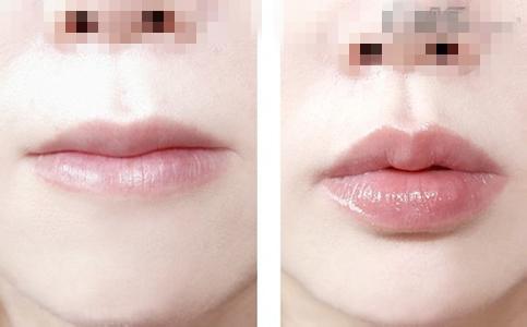 唇部綜合整形手術(shù)項(xiàng)目有哪些？唇部綜合整形多少錢？