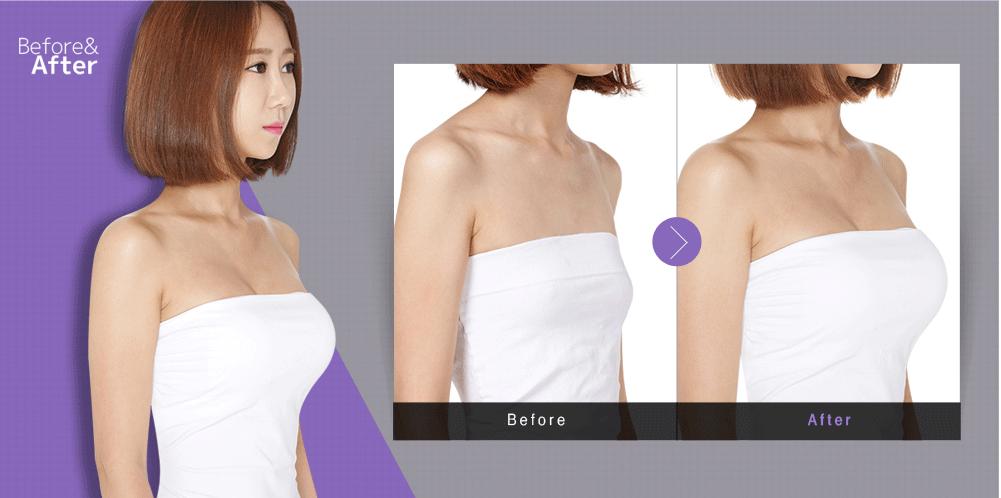 復(fù)合隆胸多少錢？復(fù)合隆胸后要注意什么？