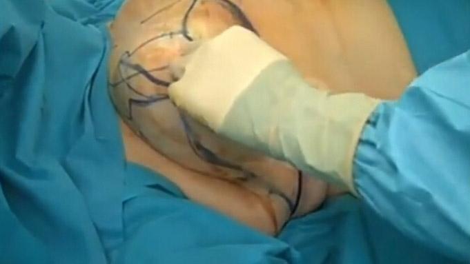 乳房縮小手術(shù)要多少錢(qián)？乳房縮小術(shù)是大手術(shù)嗎？