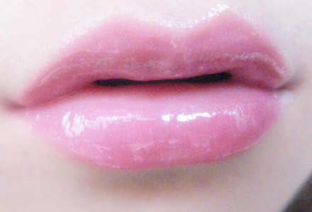 自體脂肪豐唇效果好嗎？自體脂肪豐唇大概多少錢(qián)？