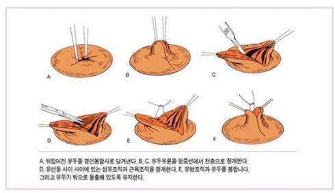 乳頭內(nèi)陷矯正手術(shù)多少錢？乳頭內(nèi)陷矯正手術(shù)多久可以恢復(fù)？