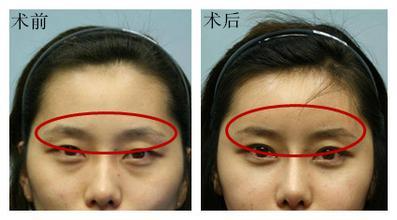 自體脂肪填充眉弓安全嗎？自體脂肪填充是永久的嗎？