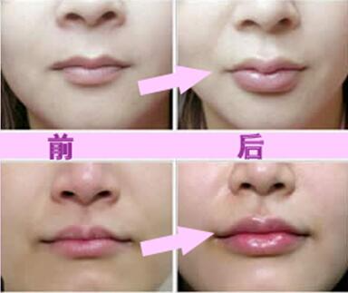 玻尿酸豐唇珠效果怎么樣？玻尿酸豐唇珠多少錢？