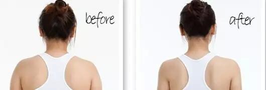 后背抽脂那些人可以做？吸脂瘦肩膀多少錢？
