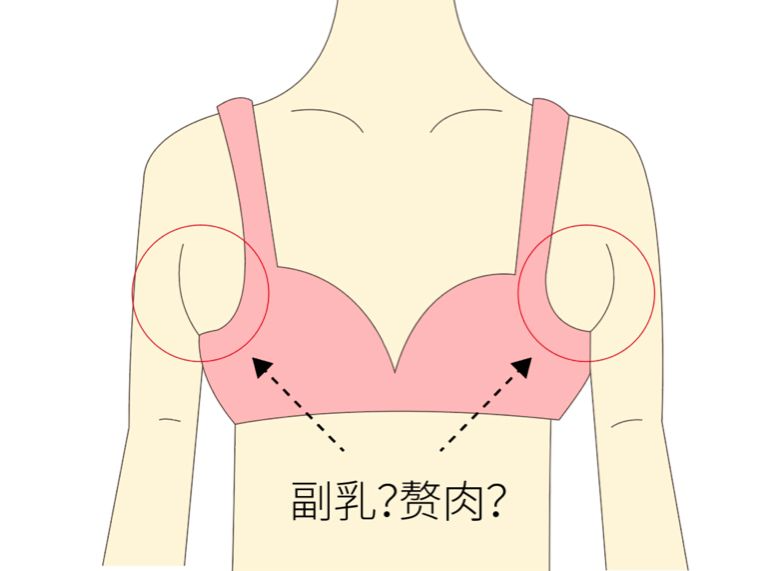 手術(shù)去副乳效果怎么樣？手術(shù)去副乳要注意什么？