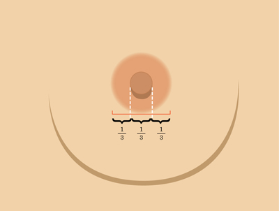 乳暈縮小如何矯正 乳暈縮小術的注意事項有哪些？