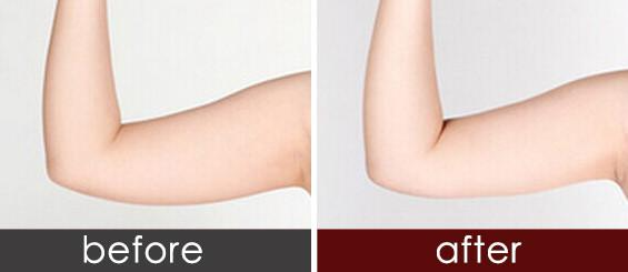手臂抽脂效果明顯嗎 ？吸脂瘦手臂會反彈嗎？