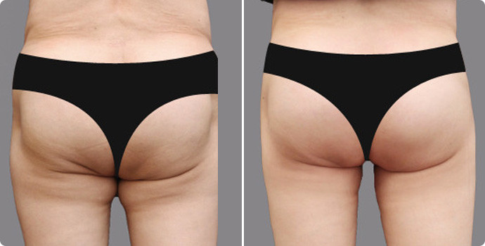 吸脂瘦臀部價格多少？吸脂瘦臀術后如何護理？