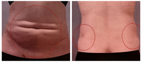 吸脂失敗了多久可以修復(fù)？吸脂失敗修復(fù)怎么解決？