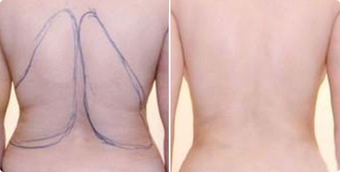 射頻溶脂瘦后背術多少錢 射頻溶脂瘦后背術后需要注意什么