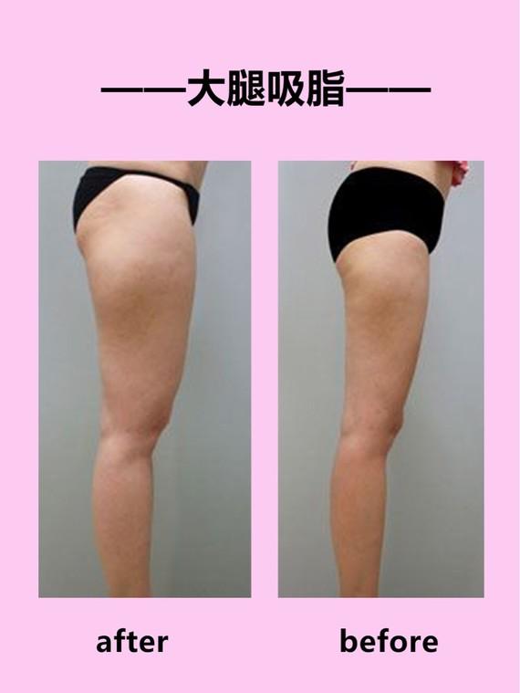 吸脂瘦大腿腫脹期是多久？大腿吸脂有什么后遺癥嗎？