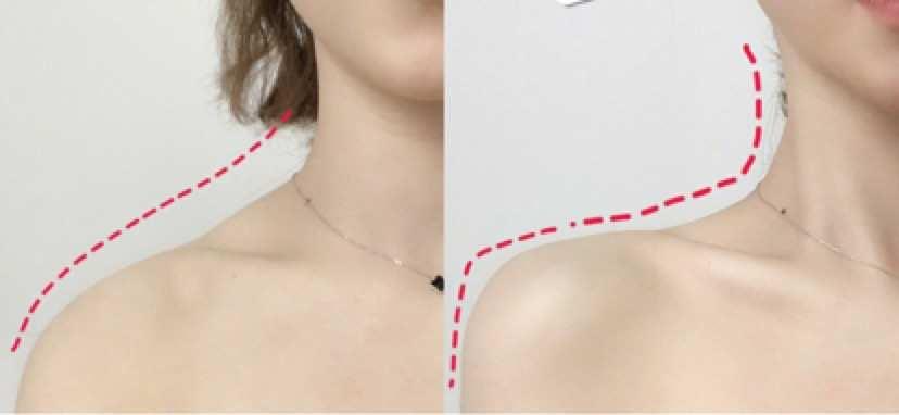 隔空溶脂瘦肩部注意事項 隔空溶脂瘦肩部如何術后護理