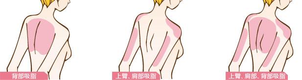 超聲溶脂瘦肩部為什么沒有效果  超聲溶脂瘦肩部有缺點(diǎn)嗎 