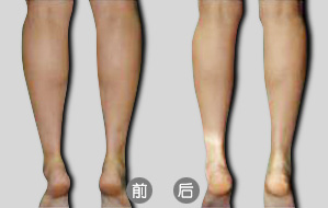 隔空溶脂瘦小腿后如何術(shù)后護理  隔空溶脂瘦小腿多少錢