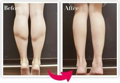 超聲溶脂瘦小腿會反彈嗎 超聲溶脂瘦小腿注意事項