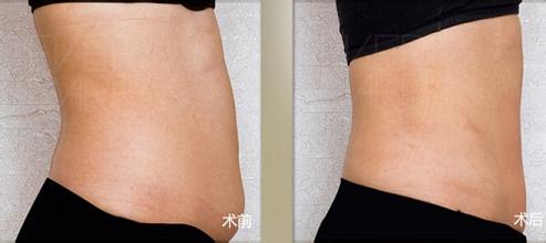 隔空溶脂瘦腹部手術(shù)有什么風(fēng)險(xiǎn)  隔空溶脂瘦腹部多少錢