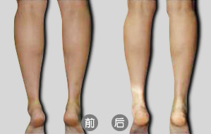 隔空溶脂瘦小腿后如何術(shù)后護(hù)理  隔空溶脂瘦小腿多少錢
