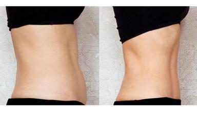 超聲溶脂瘦腹部有什么副作用 超聲波溶脂多少錢一次