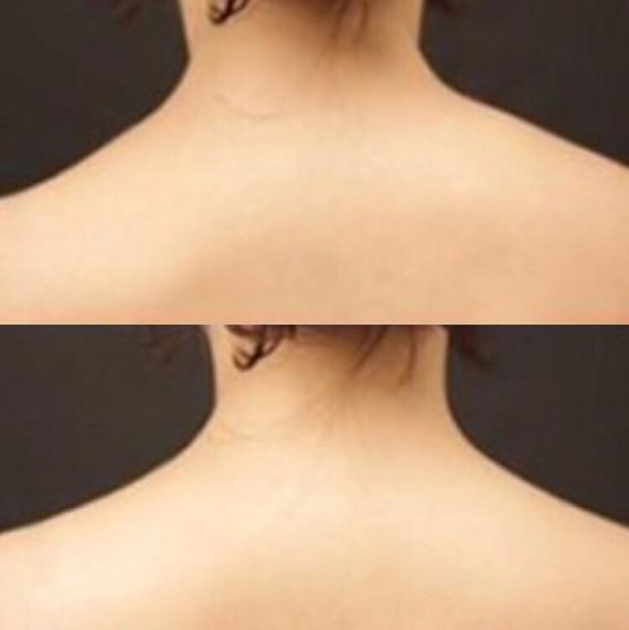 隔空溶脂瘦肩部注意事項 隔空溶脂瘦肩部如何術后護理