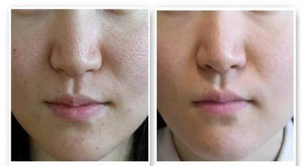 Opt嫩膚有什么功效  Opt嫩膚需要注意的事項(xiàng)