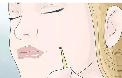 激光點(diǎn)痣要多久才會(huì)恢復(fù)？激光點(diǎn)痣多少錢？