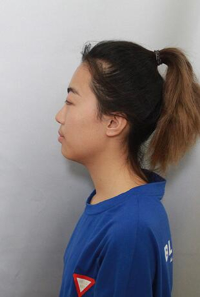  上海美萊醫(yī)療美容門(mén)診部做隆胸手術(shù)前的狀態(tài)