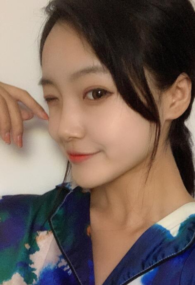 蘇州愛(ài)思特醫(yī)療美容醫(yī)院鄭曉明隆鼻案例效果分享