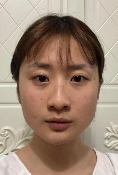 珠海陸達(dá)美容外科醫(yī)院做下頜角手術(shù)前的鼻子