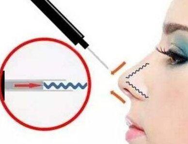 成都博雅整形埋線隆鼻有哪些優(yōu)勢？成都博雅埋線隆鼻疼嗎？