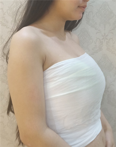  慈溪悅爾醫(yī)學(xué)美容醫(yī)院張庸柱隆胸案例效果分享