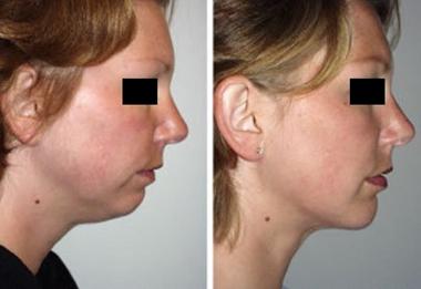 成都當(dāng)代整形透明質(zhì)酸墊下巴效果？ 透明質(zhì)酸墊下巴多少錢？