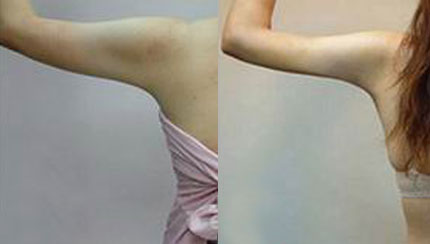  成都春語整形做手臂吸脂治術(shù)后效果好嗎？