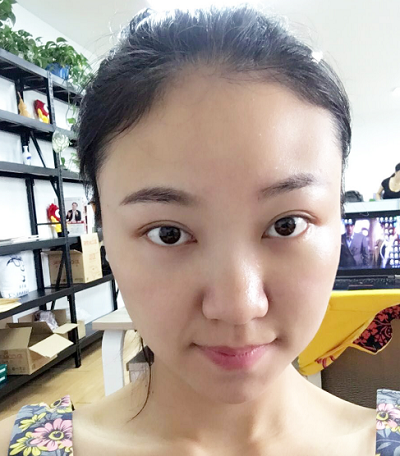 蘇州同濟醫(yī)院整形美容中心做去眼袋手術(shù)后的眼部狀態(tài)