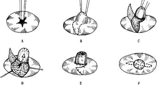 成都韓美醫(yī)療做巨乳縮小術(shù)效果如何有多少方法？