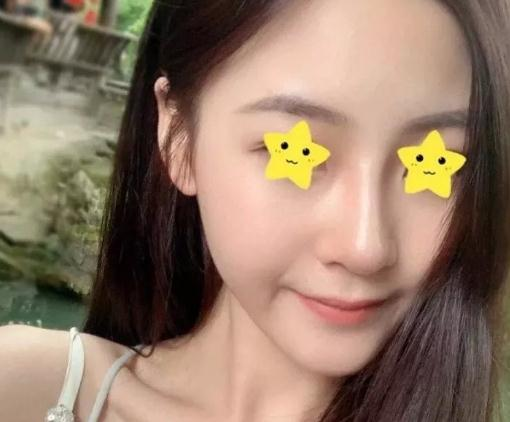 做綜合鼻，上海首爾麗格安建榮鼻綜合真人案例照片