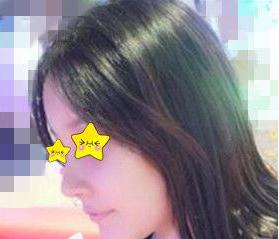 隆鼻真實(shí)案例，長沙亞韓鄭京湘隆鼻前后對比圖片