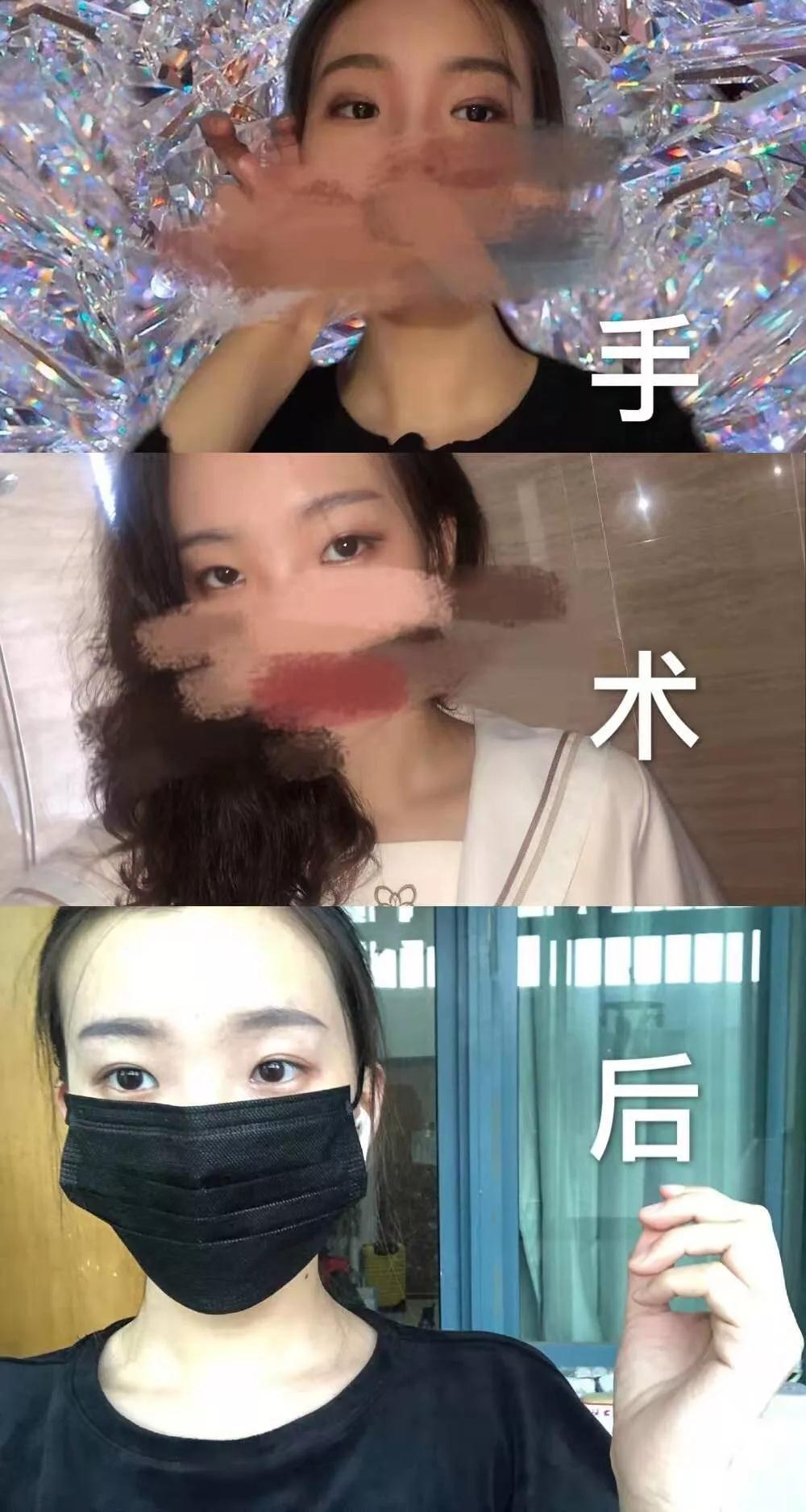 北京藝星張順慶雙眼皮案例術后效果