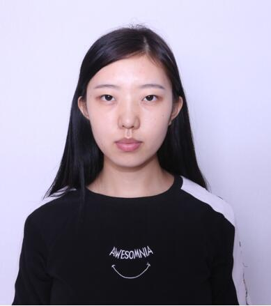 做雙眼皮案例，第四軍醫(yī)大學(xué)唐都醫(yī)院李望舟雙眼皮案例圖片