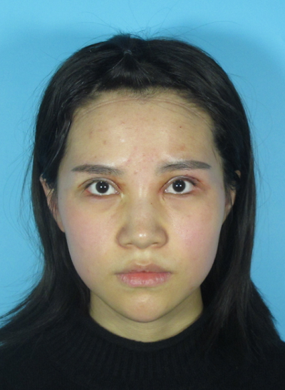 成都美立方（原華博）醫(yī)療美容醫(yī)院做眼部修復(fù)手術(shù)前的眼睛