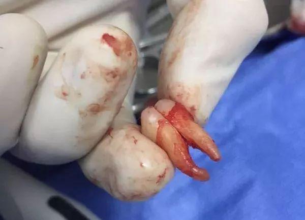 福州登特口腔拔智齒有哪些利弊？拔智齒有哪些情況？