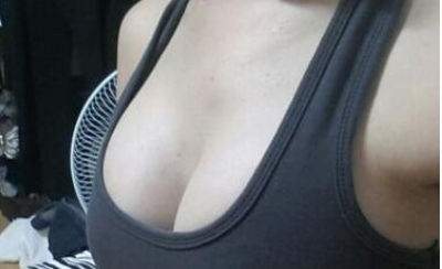 成都美立方（原華博）醫(yī)療美容醫(yī)院做假體隆胸術(shù)后的最終效果