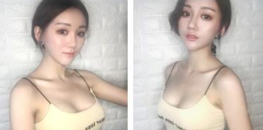 武漢米蘭醫(yī)療美容門診部做假體隆胸術(shù)后的第18天