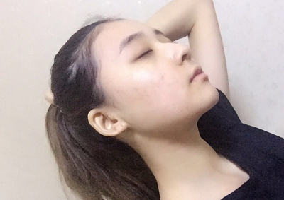 北京京民醫(yī)院（原釣魚臺醫(yī)院）整形外科做下頜骨手術(shù)后去掉頭套